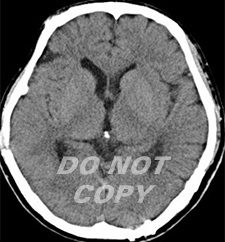 退院後の頭部CT